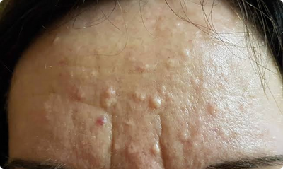 White Bumps on the Face: Causes, Types, Treatment, and Prevention