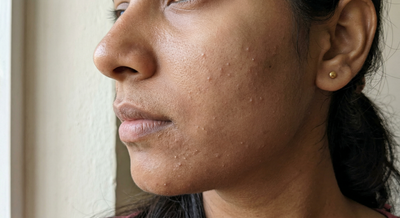 Whiteheads on Face: Causes, Treatment, and Prevention (A Scientific Yet Practical Guide)